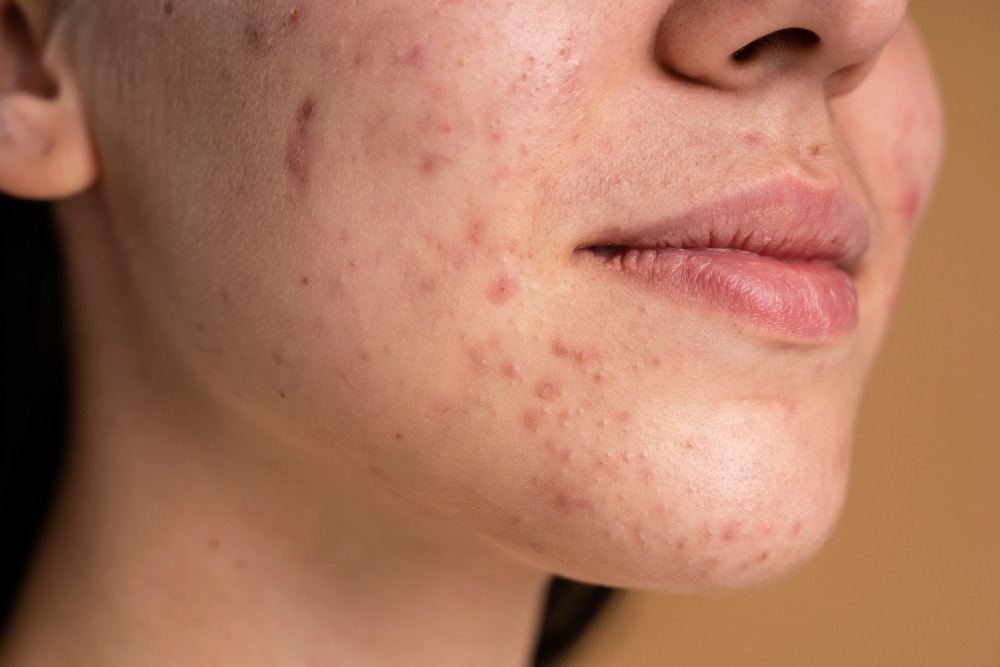 Skin purging or just acne? 4 ways to tell the difference!