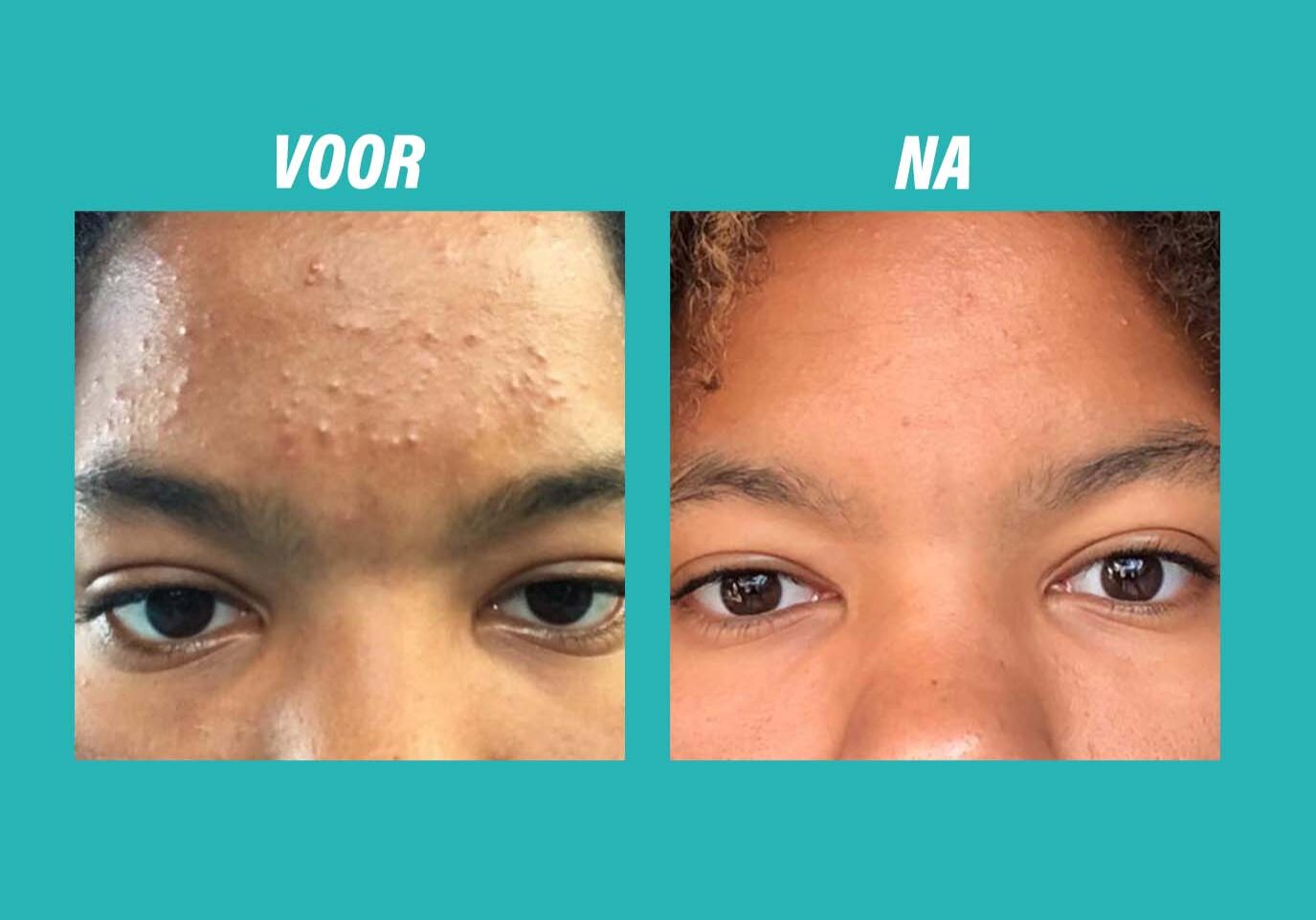 YUN Before-after GLORIA NL