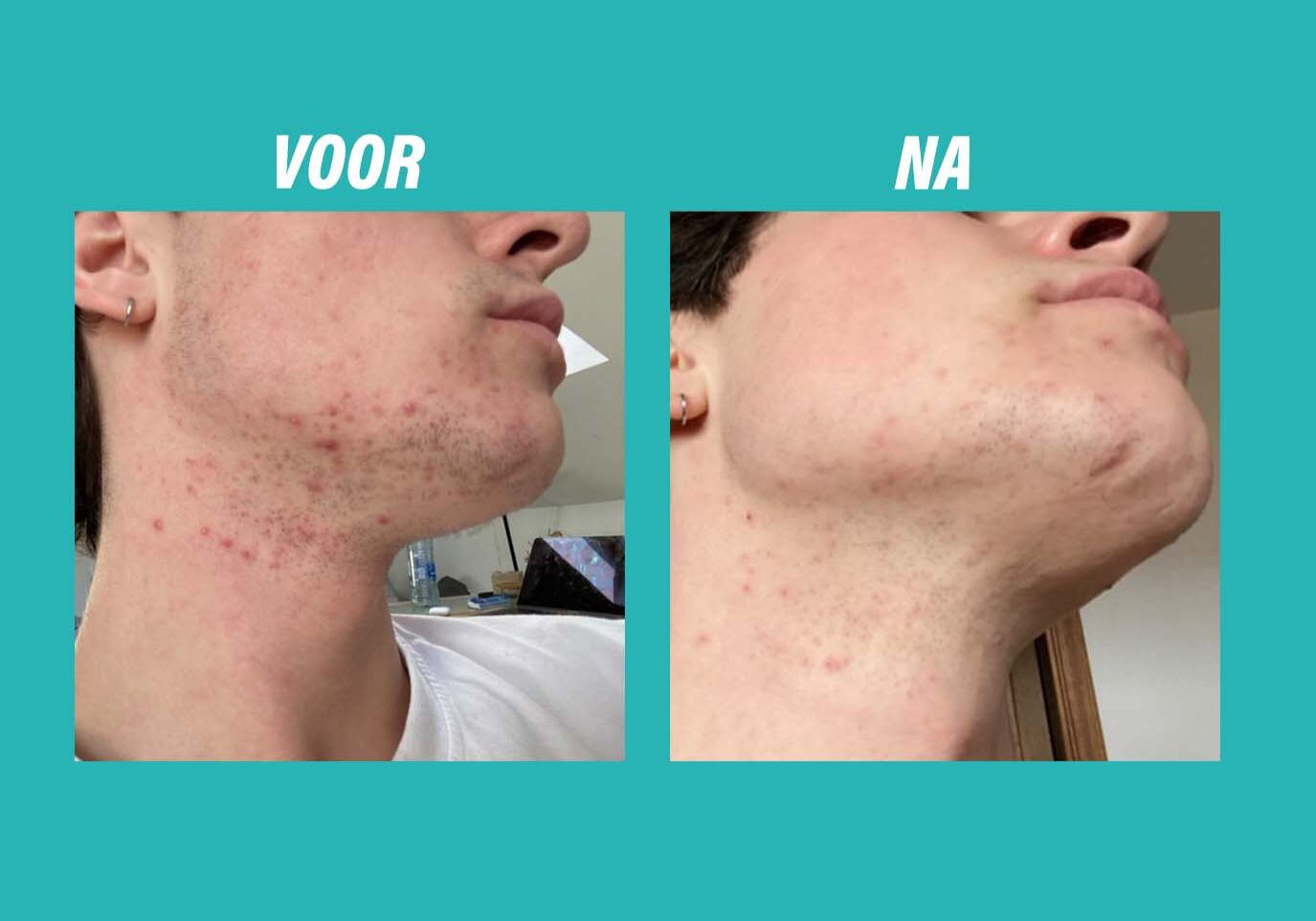 YUN Before-after PIETER NL